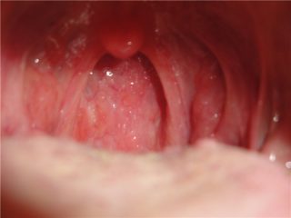 От чего появляются в горле волдыри и пузырьки? А также методы их лечения