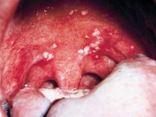 Может ли быть в горле герпес? Симптомы и лечение вирусной инфекции