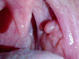 Почему возникает киста в горле? Способы лечения патологических образований