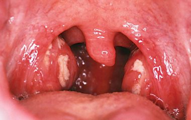 Что такое ангина Симановского-Венсана? Причины и способы лечения болезни