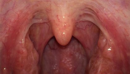 В чем разница между миндалинами, гландами и аденоидами? Когда нужна операция?