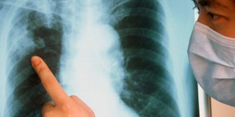 Что такое открытая и закрытая формы туберкулеза? Все отличия этих вариантов болезни